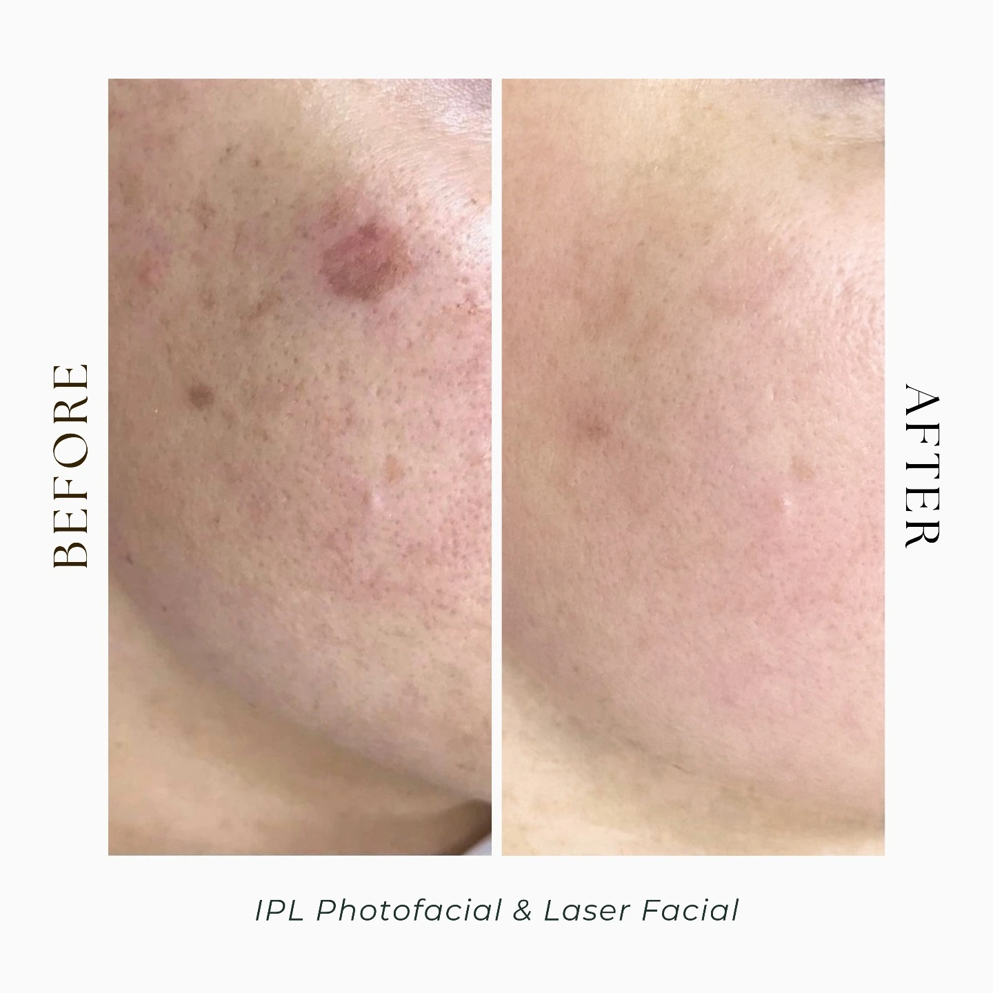 IPL laser-laser facial-before and after