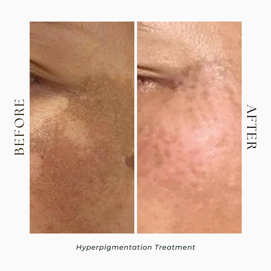 hyperpigmentation treatment before and after-best laser facial treatment