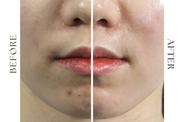 lala peel before after 2