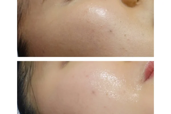 lala peel before after 4
