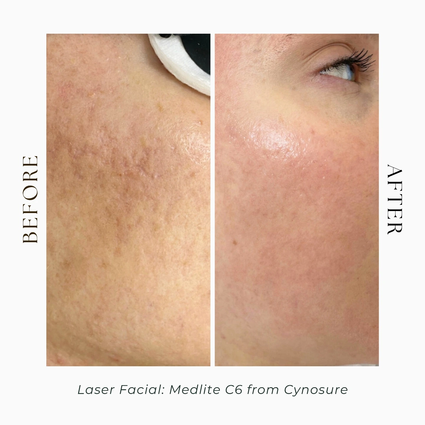 laser facial before and after-medlite c6 laser-laser skin resurfacing toronto