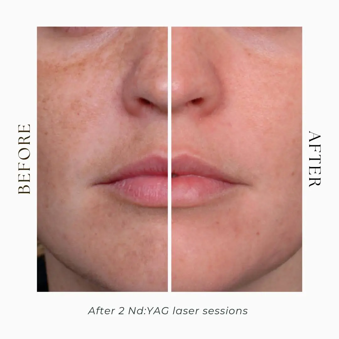 best laser facial treatment-q switched nd yag laser before and after-laser facial toronto