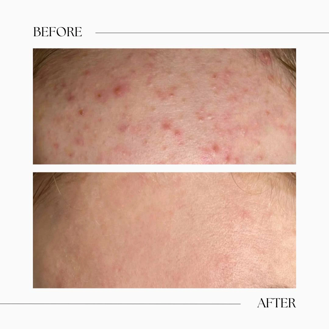 hydrafacial before after-acne treatment-chemical peel
