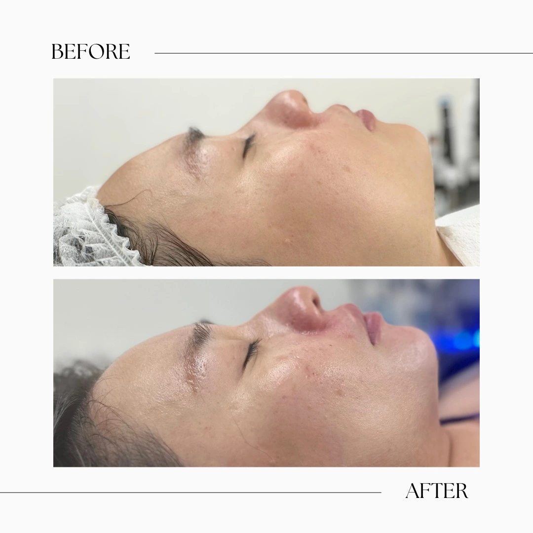 hydrafacial before and after-acne treatment-hydrafacial toronto