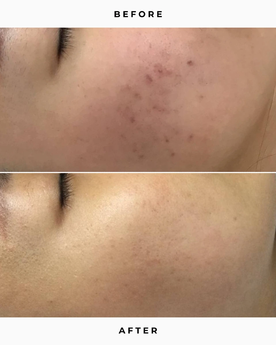 hydrafacial before and after-microneedling toronto-laser facial