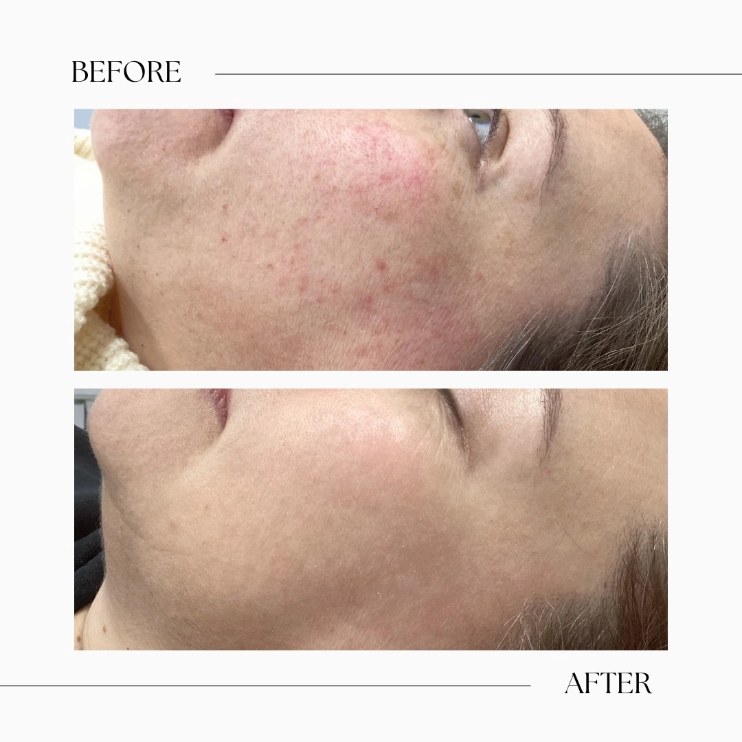IPL Toronto-IPL treatment-Signature Beauty Lounge