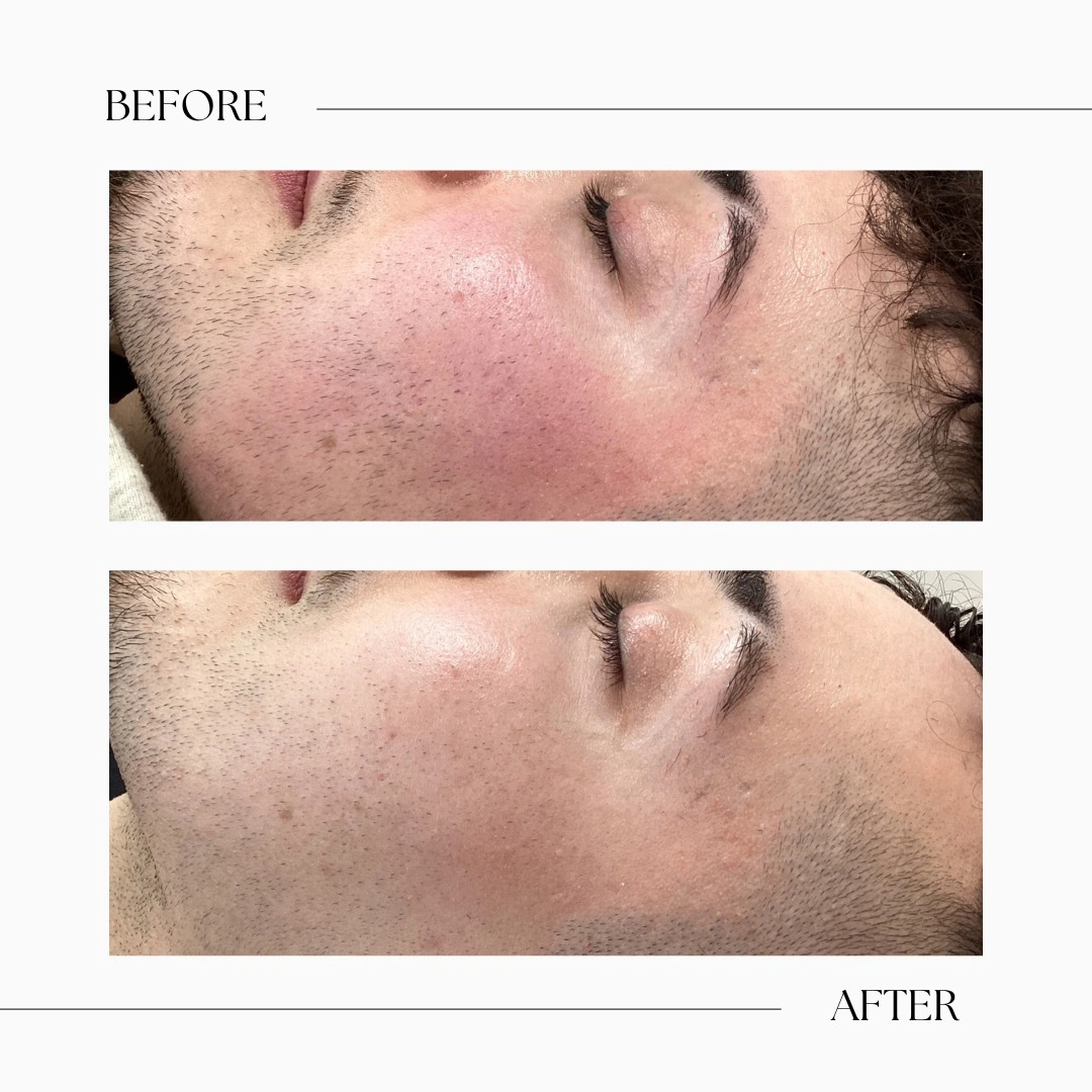 IPL Toronto-IPL treatment-Signature Beauty Lounge