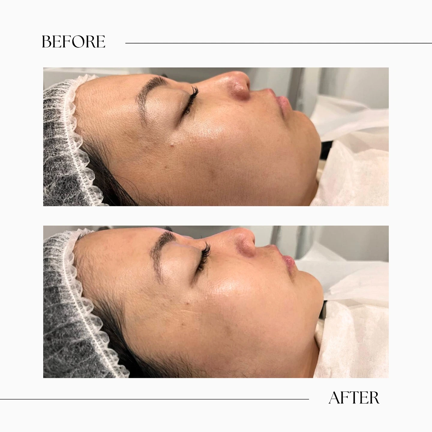 IPL Toronto-IPL treatment-Signature Beauty Lounge