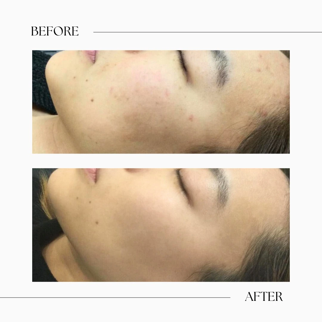 IPL Toronto-IPL treatment-Mesotherapy Toronto
